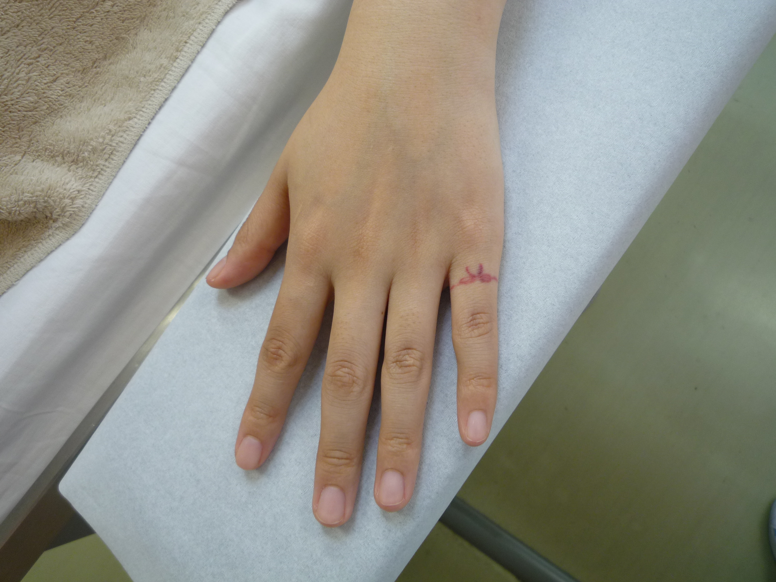 刺青を消したい 指 横浜で働く美容外科院長の美容整形ここだけの話ブログ