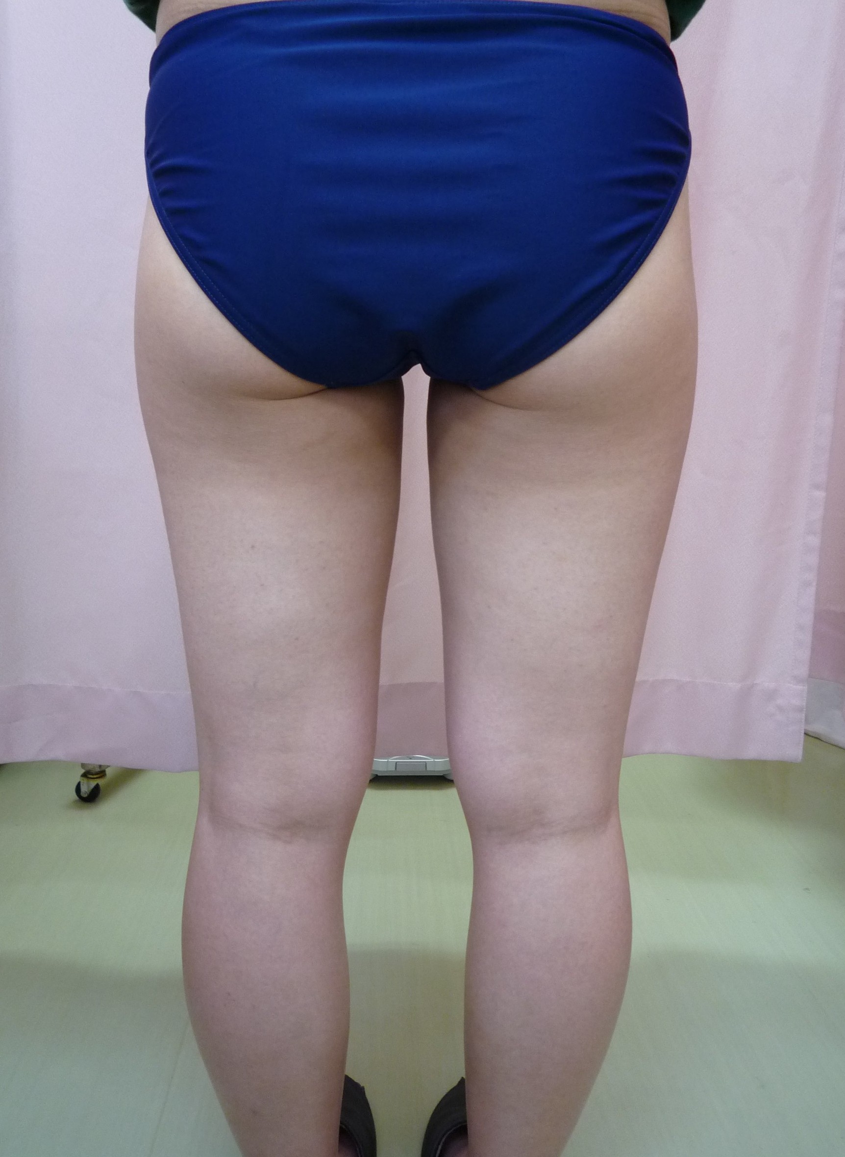 ｑ ａ１３ ｑ 脚を細くしたい 脂肪吸引と脂肪溶解注射 どちらがいいの 画像あり 横浜で働く美容外科院長の美容整形ここだけの話ブログ