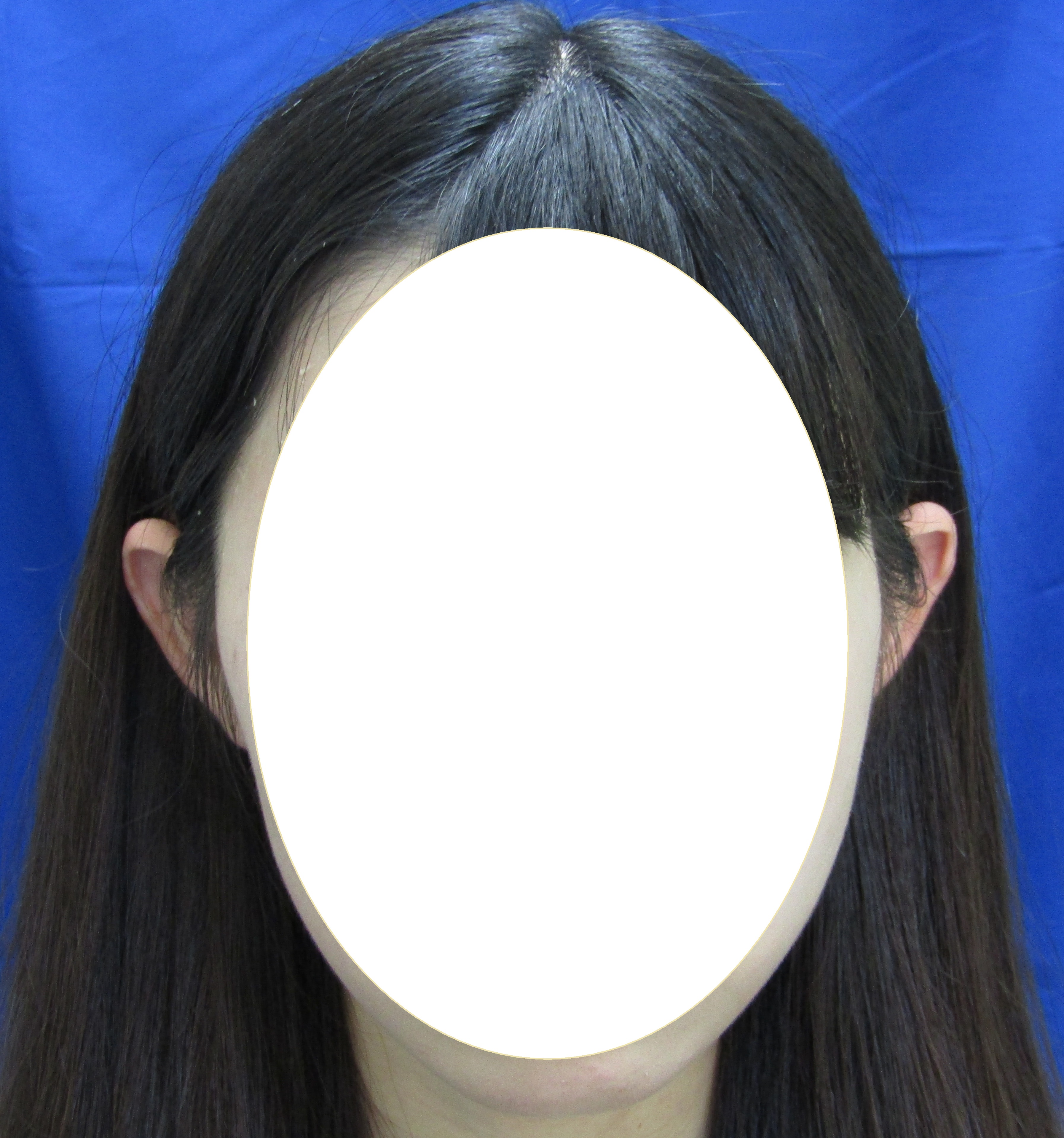 立ち耳 少しだけど治したい 画像あり 横浜で働く美容外科院長の美容整形ここだけの話ブログ