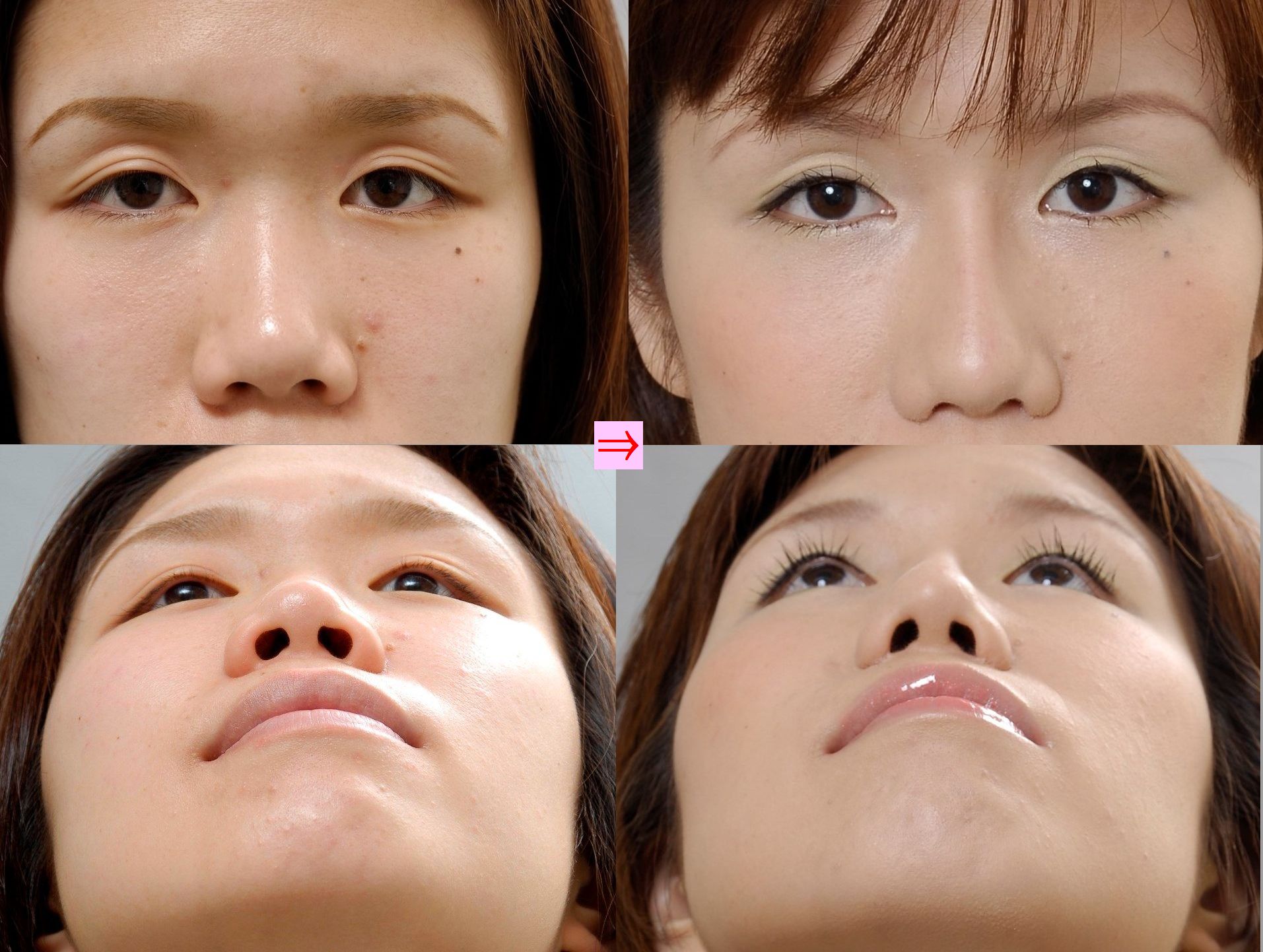 隆鼻術と整鼻術の複合手術 画像あり 横浜で働く美容外科院長の美容整形ここだけの話ブログ