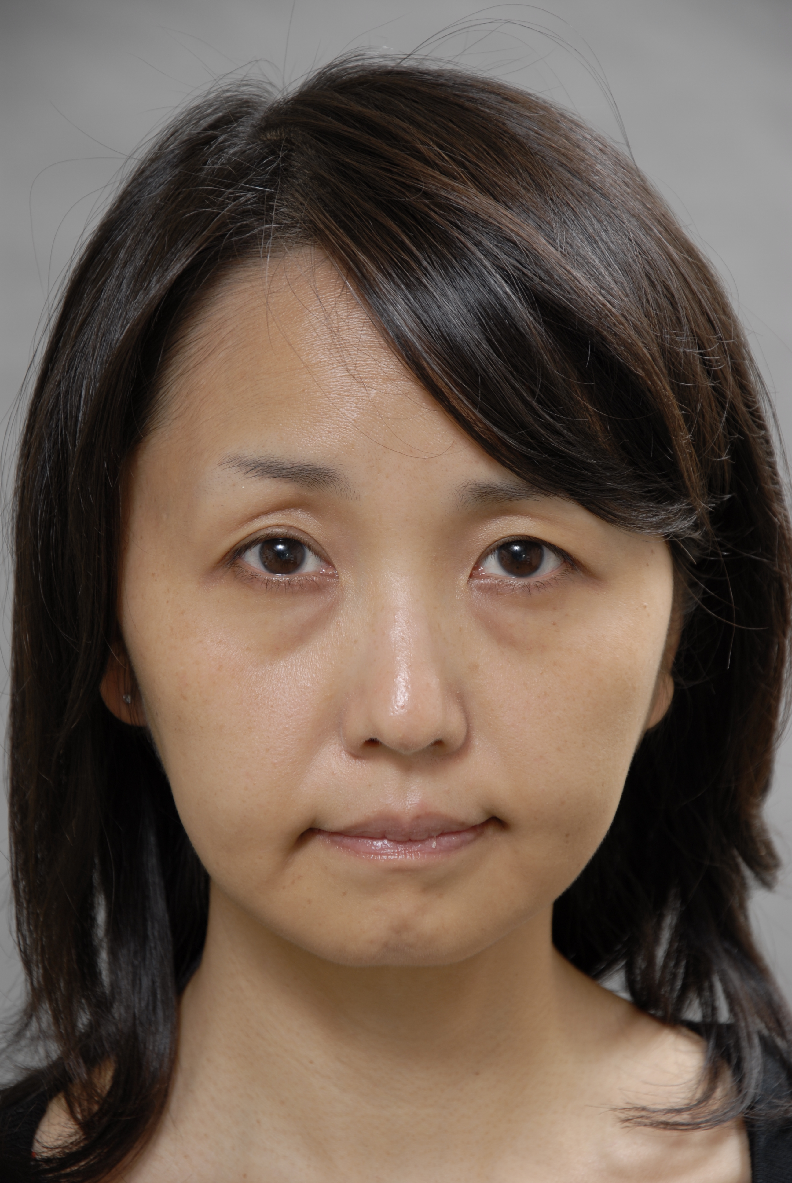 フェイスリフトの症例解説 ３０代 画像あり 横浜で働く美容外科院長の美容整形ここだけの話ブログ